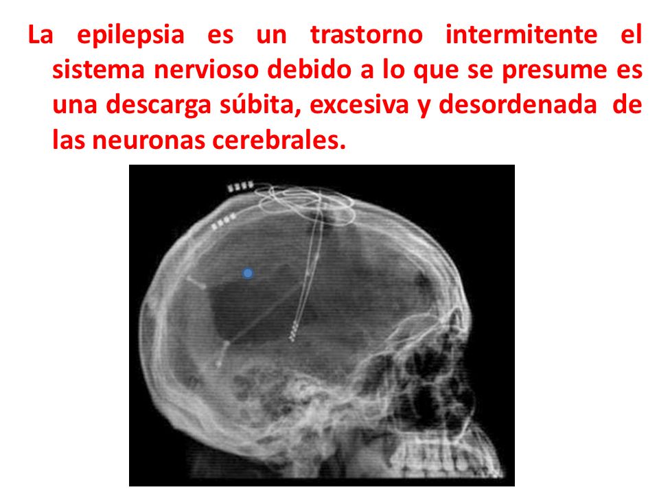 La epilepsia es un trastorno intermitente el sistema nervioso debido a lo que se presume es una descarga súbita, excesiva y desordenada de las neuronas cerebrales.