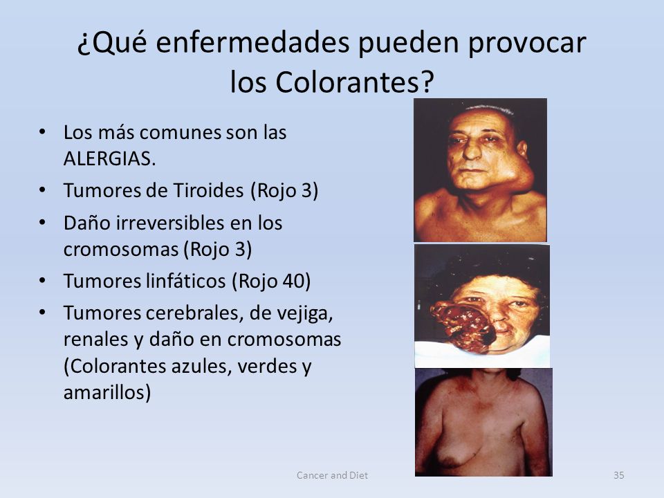 ¿Qué enfermedades pueden provocar los Colorantes