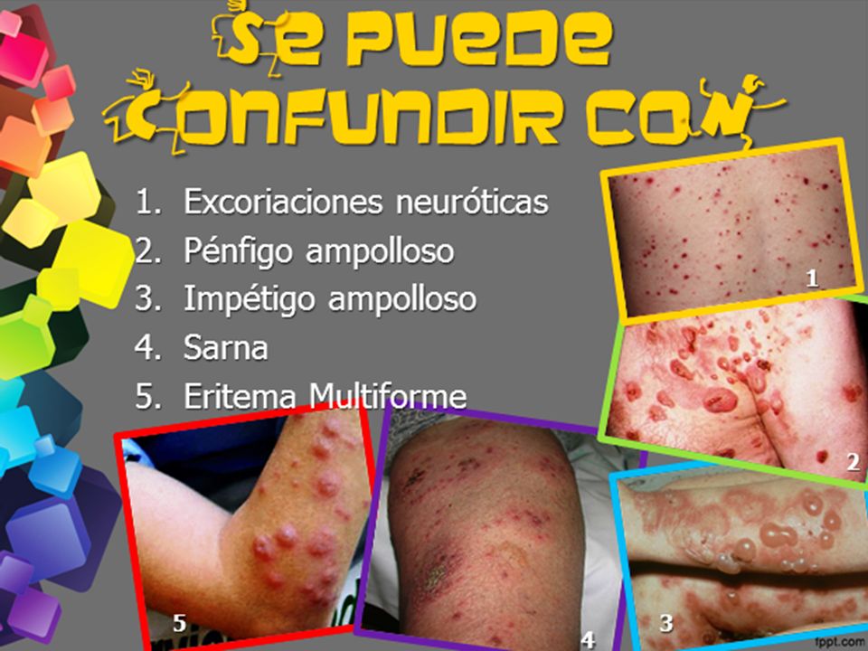 c n s e puede onfundir co Excoriaciones neuróticas Pénfigo ampolloso