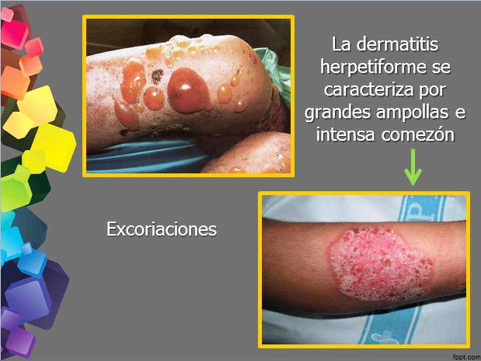 La dermatitis herpetiforme se caracteriza por grandes ampollas e intensa comezón