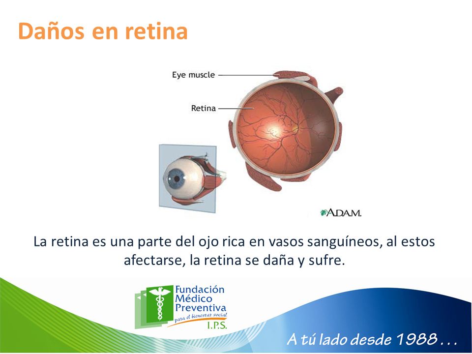 Daños en retina La retina es una parte del ojo rica en vasos sanguíneos, al estos afectarse, la retina se daña y sufre.