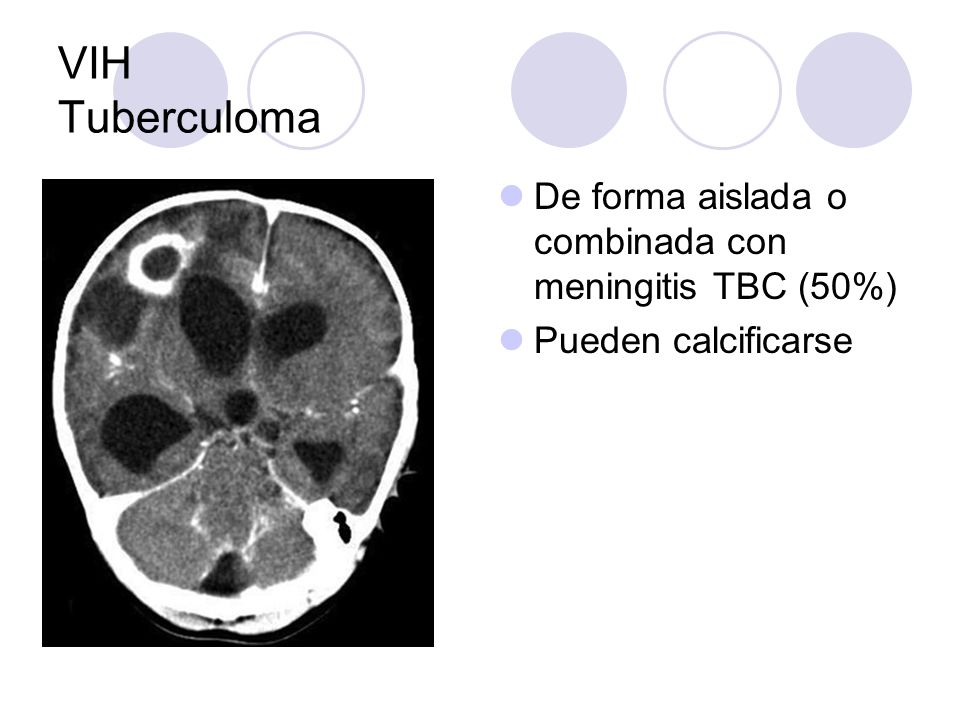 VIH Tuberculoma De forma aislada o combinada con meningitis TBC (50%)