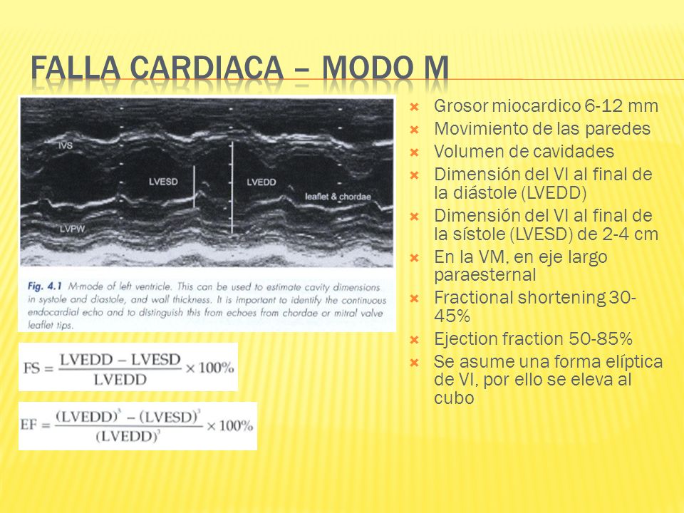 Falla cardiaca – modo m Grosor miocardico 6-12 mm