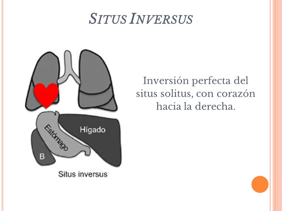 Inversión perfecta del situs solitus, con corazón hacia la derecha.