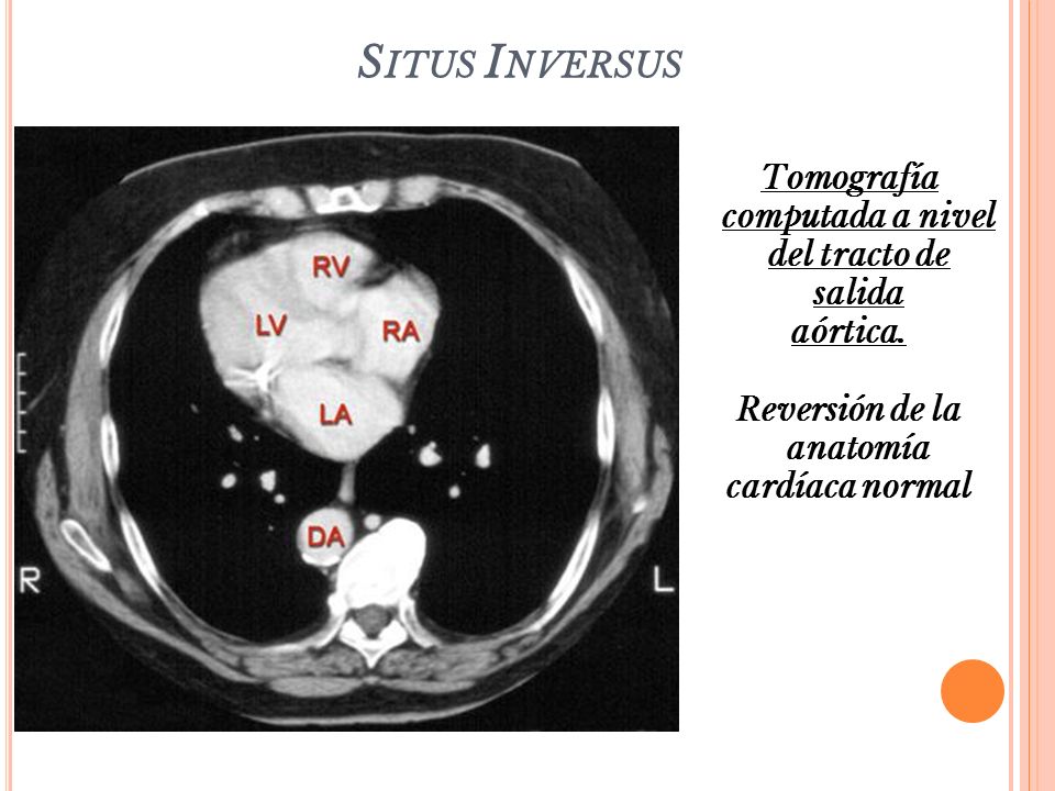Situs Inversus Tomografía computada a nivel del tracto de salida