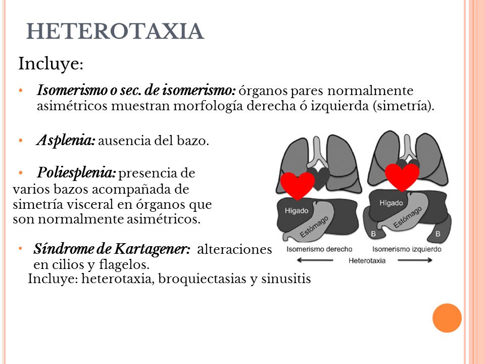 HETEROTAXIA Incluye: Isomerismo o sec. de isomerismo: órganos pares normalmente asimétricos muestran morfología derecha ó izquierda (simetría).