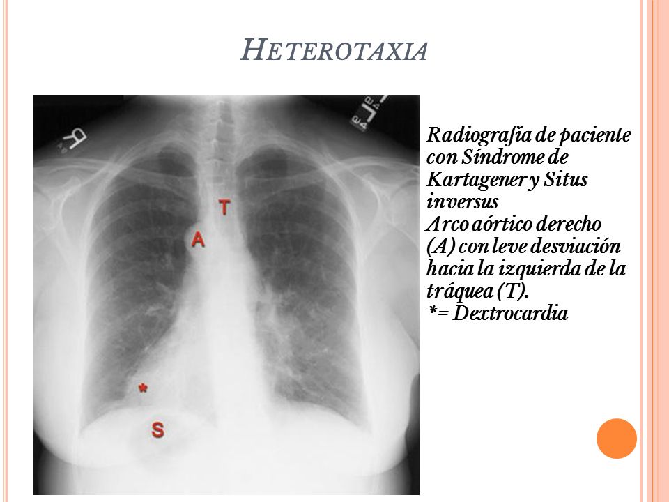 Heterotaxia Radiografía de paciente con Síndrome de Kartagener y Situs inversus.