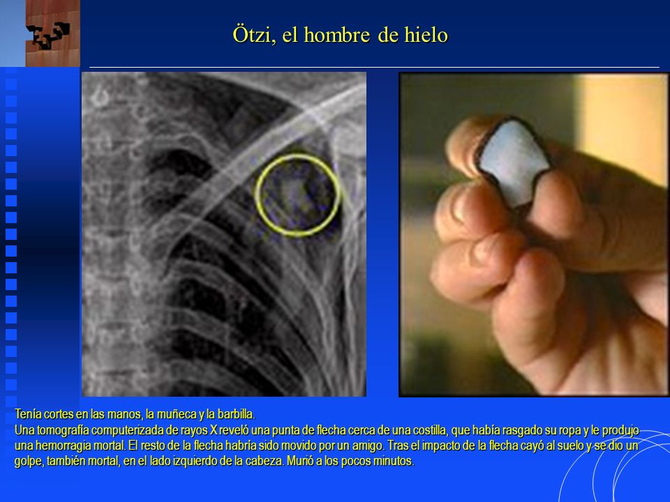 Ötzi, el hombre de hielo Tenía cortes en las manos, la muñeca y la barbilla.