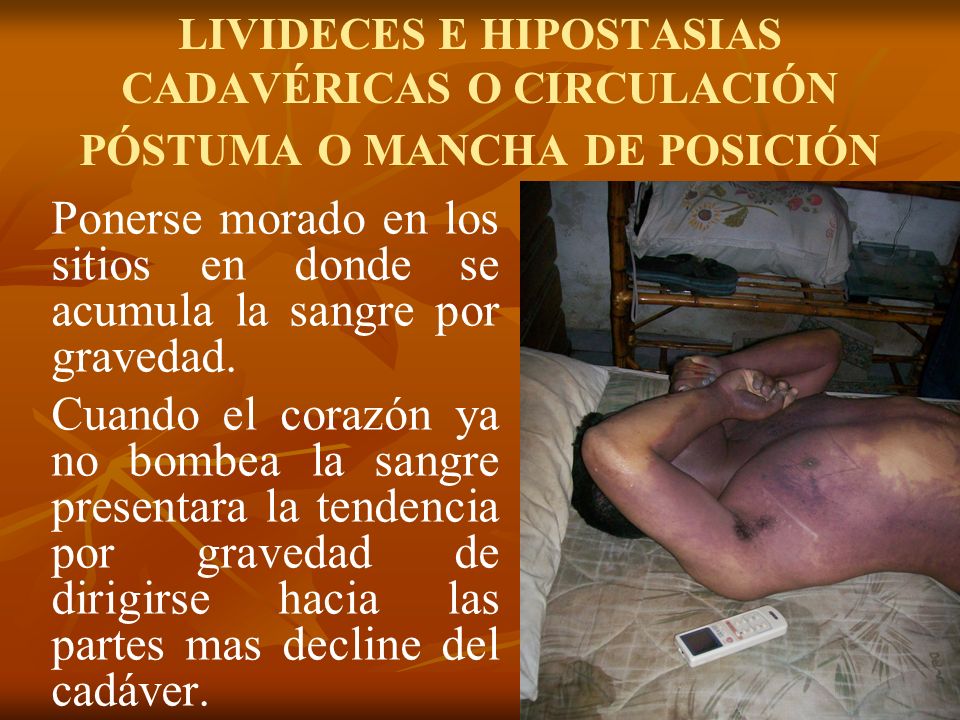 LIVIDECES E HIPOSTASIAS CADAVÉRICAS O CIRCULACIÓN PÓSTUMA O MANCHA DE POSICIÓN