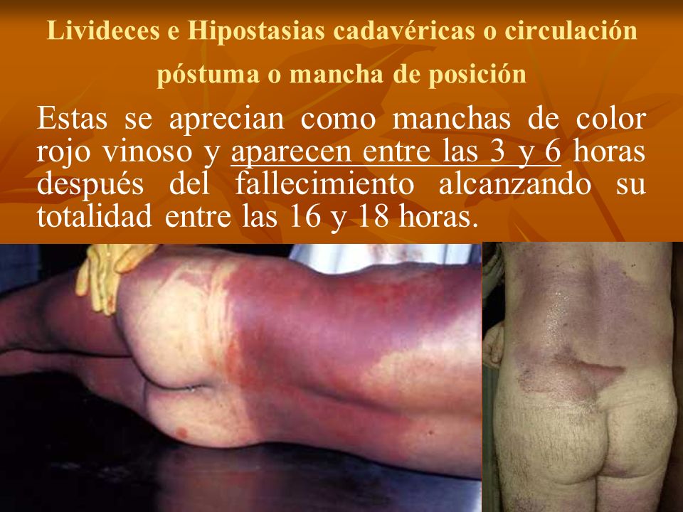 Livideces e Hipostasias cadavéricas o circulación póstuma o mancha de posición