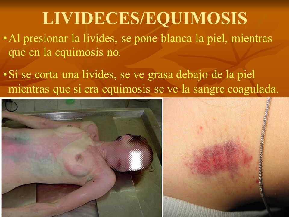 LIVIDECES/EQUIMOSIS Al presionar la livides, se pone blanca la piel, mientras que en la equimosis no.
