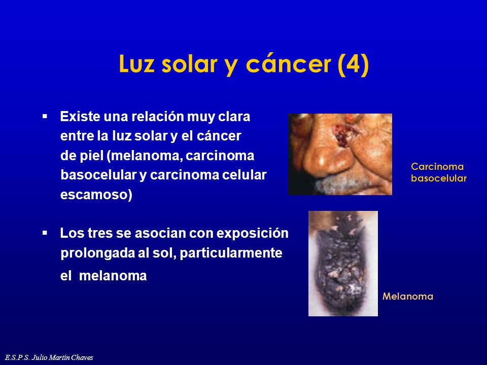 Luz solar y cáncer (4) Existe una relación muy clara