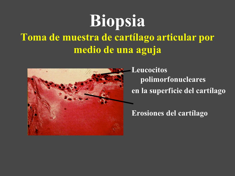 Biopsia Toma de muestra de cartílago articular por medio de una aguja