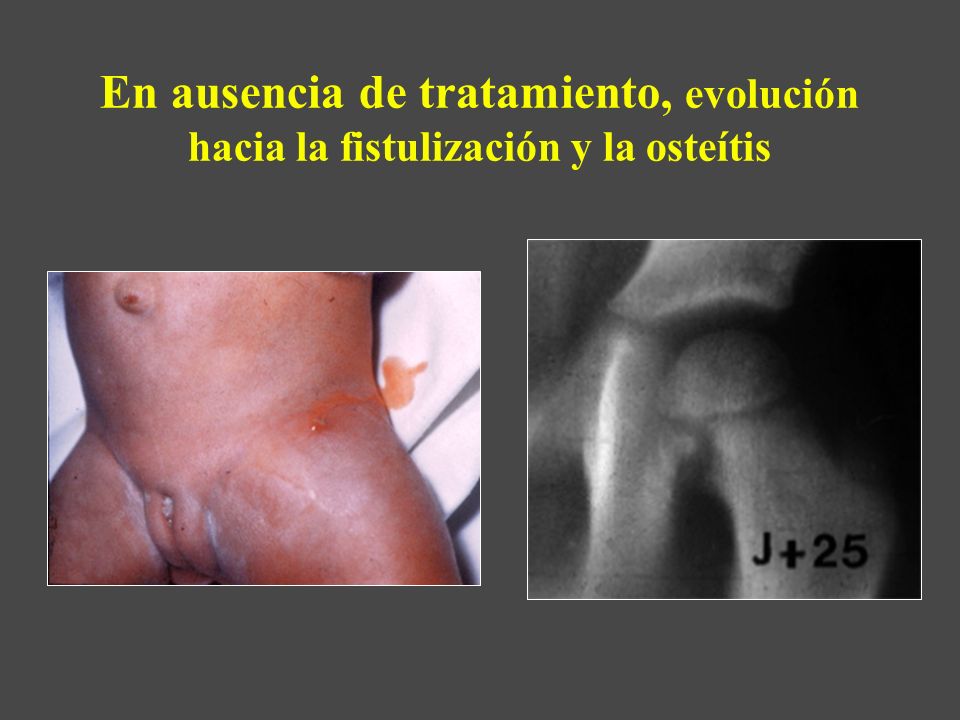 En ausencia de tratamiento, evolución hacia la fistulización y la osteítis