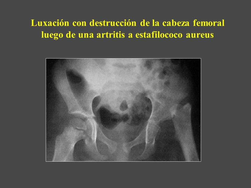 Luxación con destrucción de la cabeza femoral luego de una artritis a estafilococo aureus