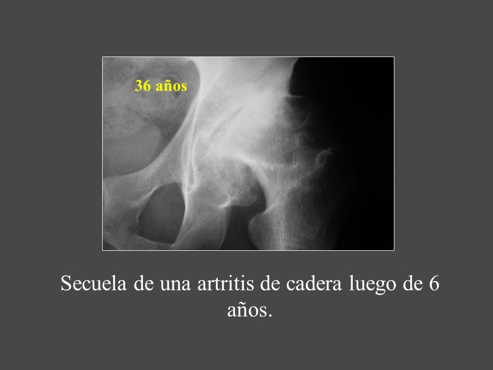 Secuela de una artritis de cadera luego de 6 años.