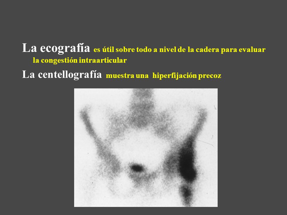 La ecografía es útil sobre todo a nivel de la cadera para evaluar la congestión intraarticular