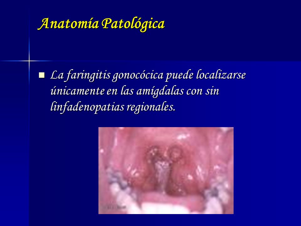 Anatomía Patológica La faringitis gonocócica puede localizarse únicamente en las amígdalas con sin linfadenopatias regionales.