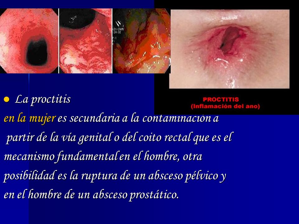 La proctitis en la mujer es secundaria a la contaminación a. partir de la vía genital o del coito rectal que es el.