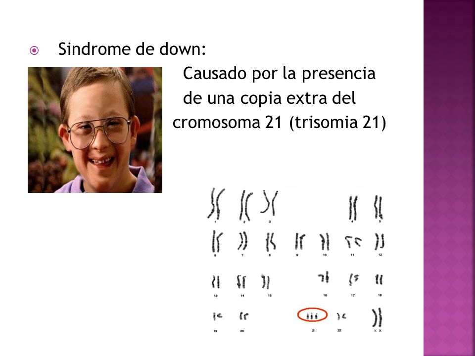 Sindrome de down: Causado por la presencia de una copia extra del cromosoma 21 (trisomia 21)
