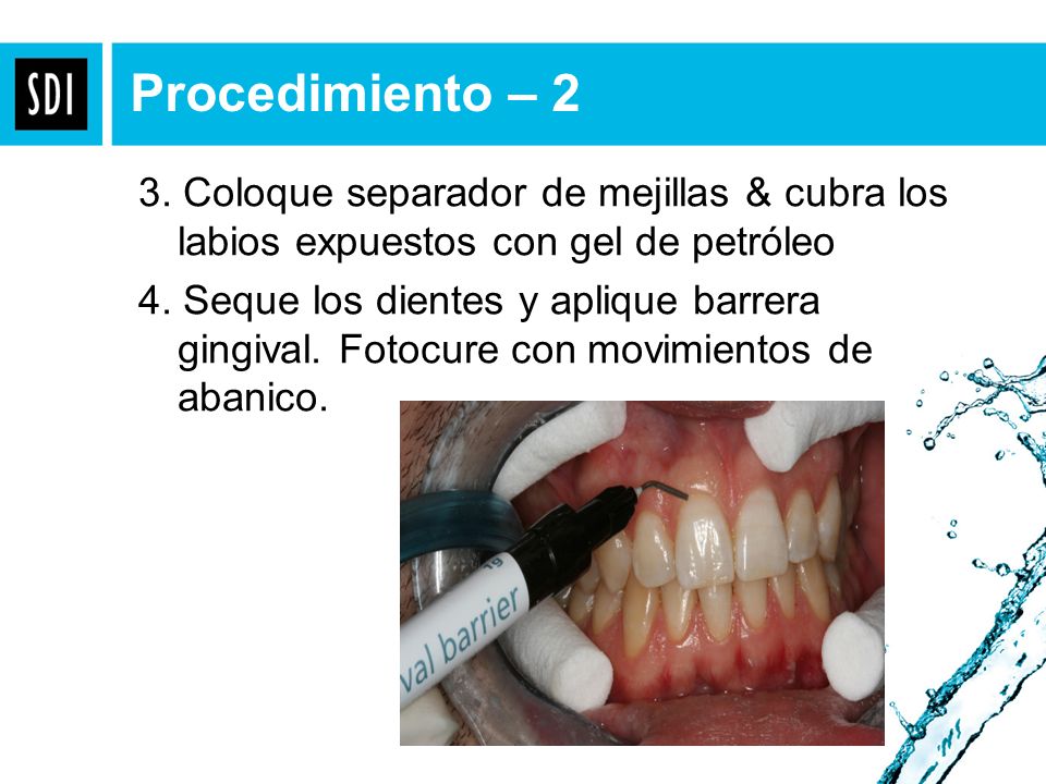 Procedimiento – 2 3. Coloque separador de mejillas & cubra los labios expuestos con gel de petróleo.