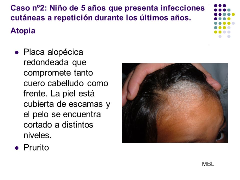 Caso nº2: Niño de 5 años que presenta infecciones cutáneas a repetición durante los últimos años. Atopia