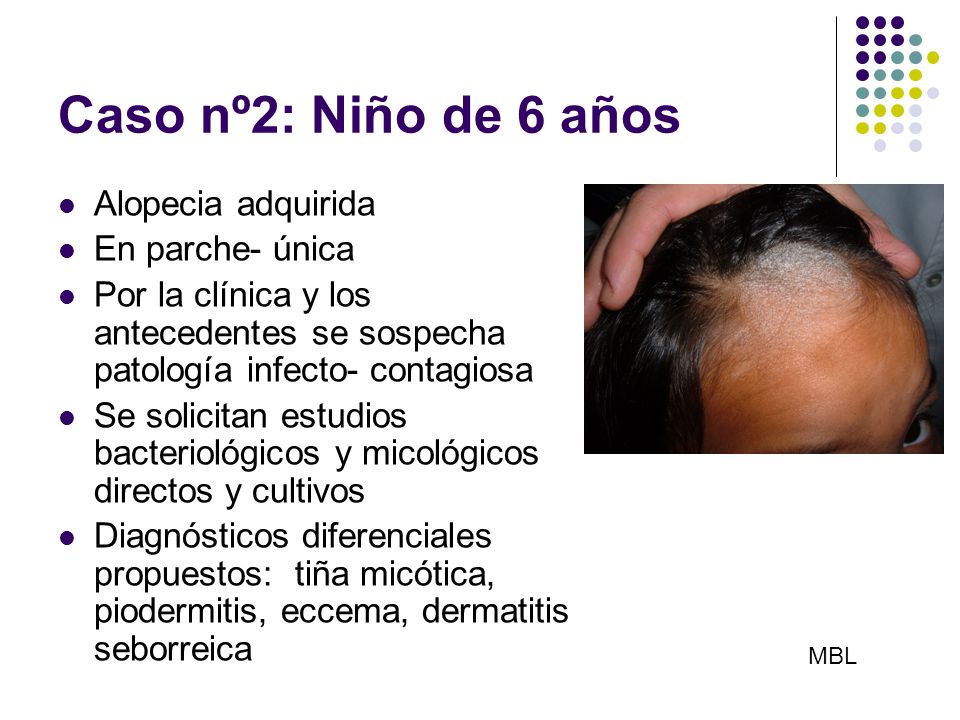 Caso nº2: Niño de 6 años Alopecia adquirida En parche- única