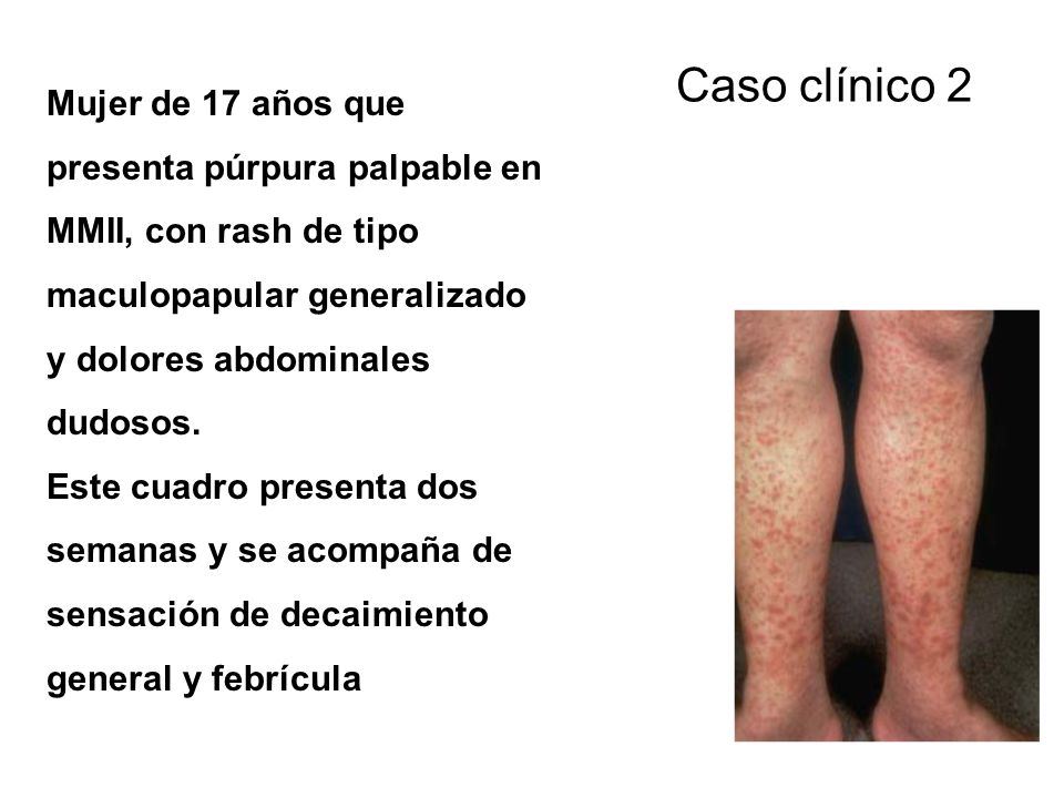Caso clínico 2 Mujer de 17 años que presenta púrpura palpable en MMII, con rash de tipo maculopapular generalizado y dolores abdominales dudosos.
