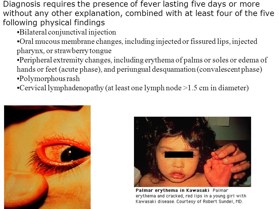 Diagnosis requires the presence of fever lasting five days or more without any other explanation, combined with at least four of the five following physical findings