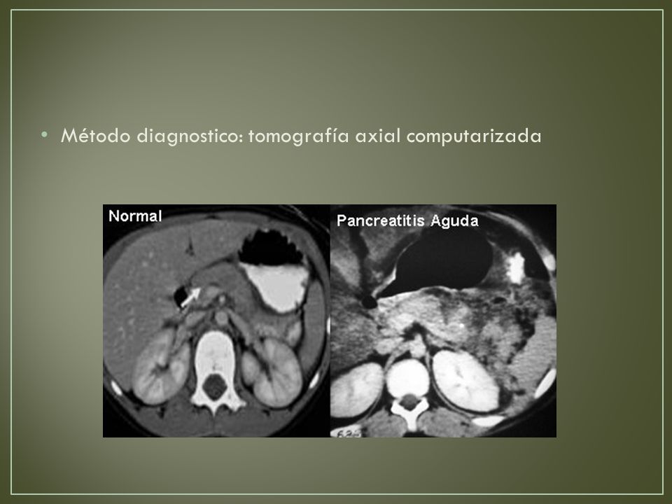 Método diagnostico: tomografía axial computarizada