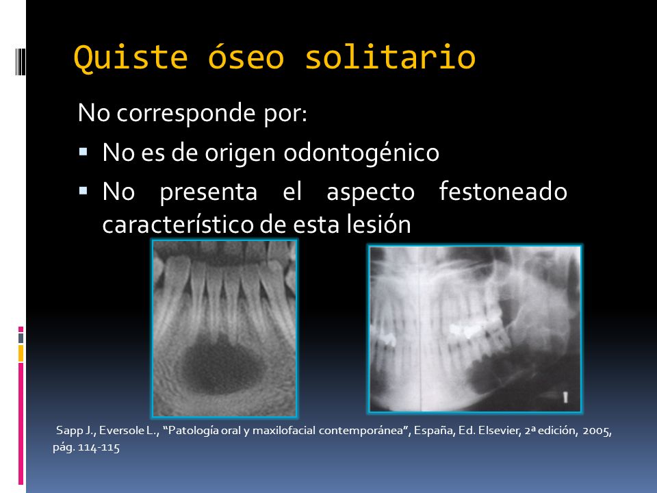 Quiste óseo solitario No corresponde por: No es de origen odontogénico