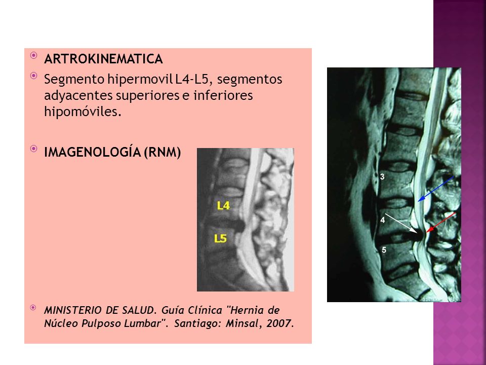 ARTROKINEMATICA Segmento hipermovil L4-L5, segmentos adyacentes superiores e inferiores hipomóviles.