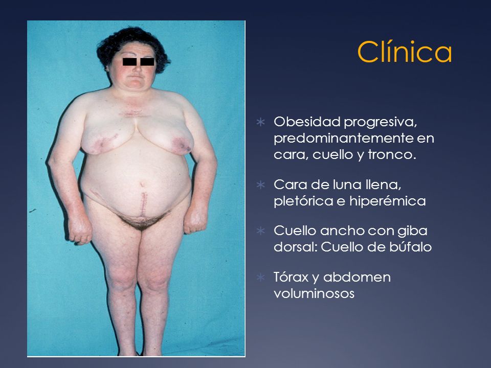 Clínica Obesidad progresiva, predominantemente en cara, cuello y tronco. Cara de luna llena, pletórica e hiperémica.
