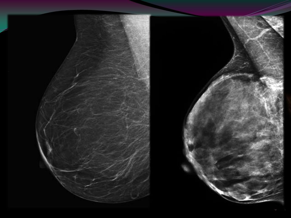Introducción El cáncer de mama es la segunda causa de muerte