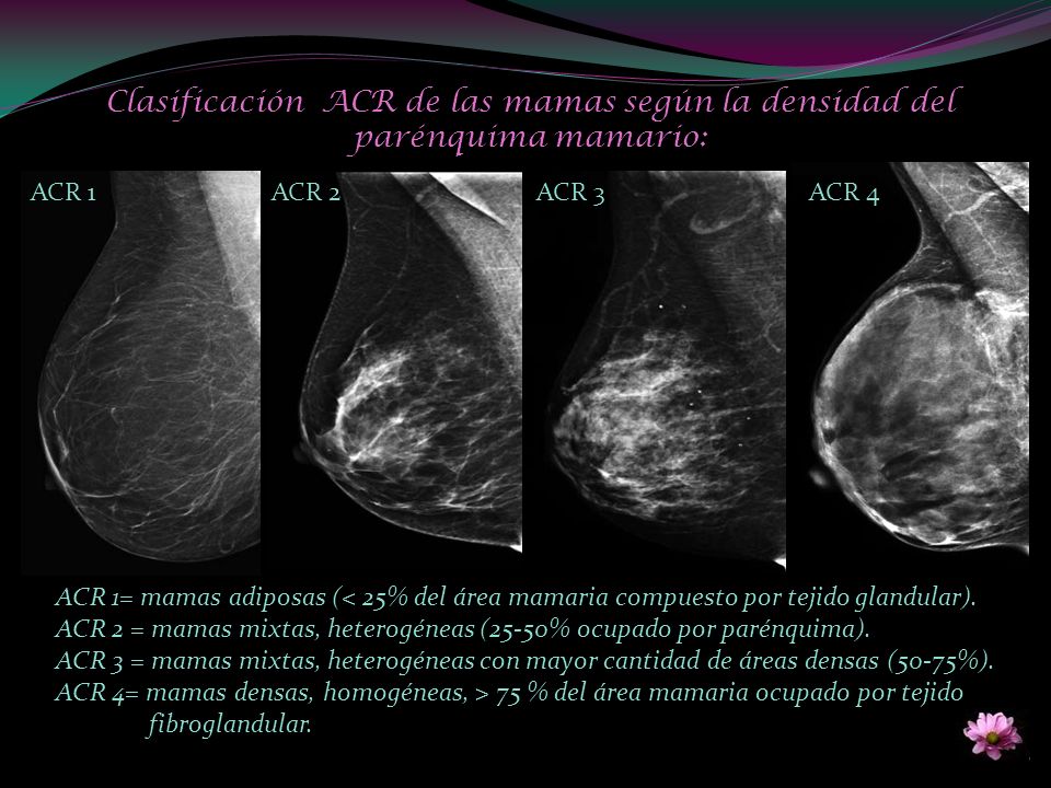 Clasificación ACR de las mamas según la densidad del parénquima mamario: