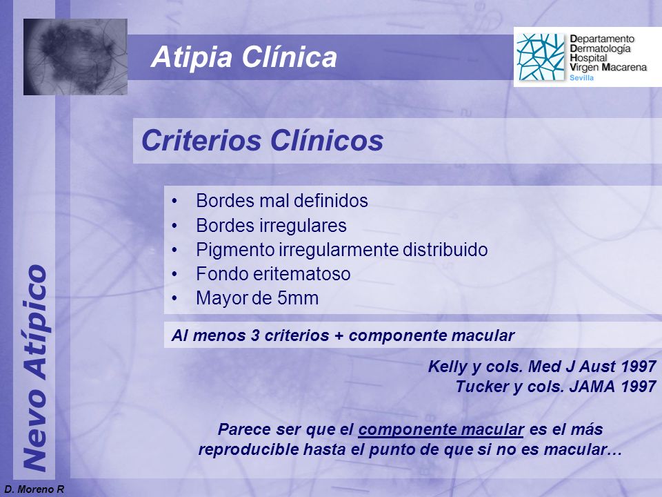 Atipia Clínica Criterios Clínicos Nevo Atípico Bordes mal definidos