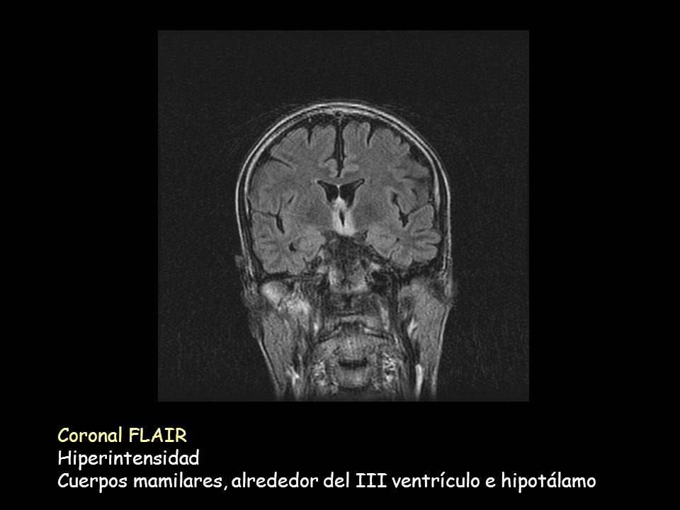 Coronal FLAIR Hiperintensidad Cuerpos mamilares, alrededor del III ventrículo e hipotálamo