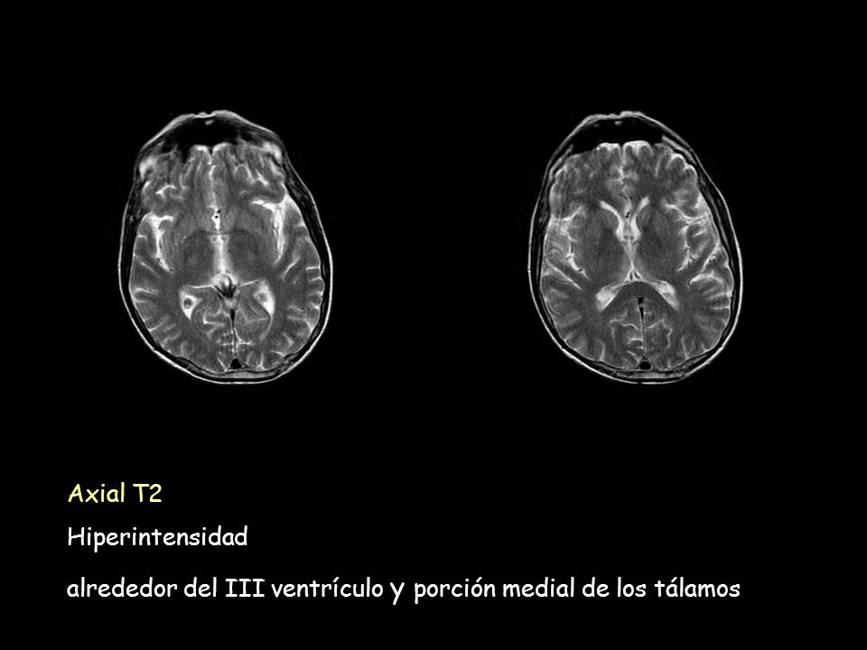 Axial T2 Hiperintensidad alrededor del III ventrículo y porción medial de los tálamos