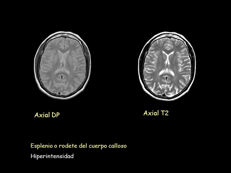 Axial T2 Axial DP T2 DP Esplenio o rodete del cuerpo calloso