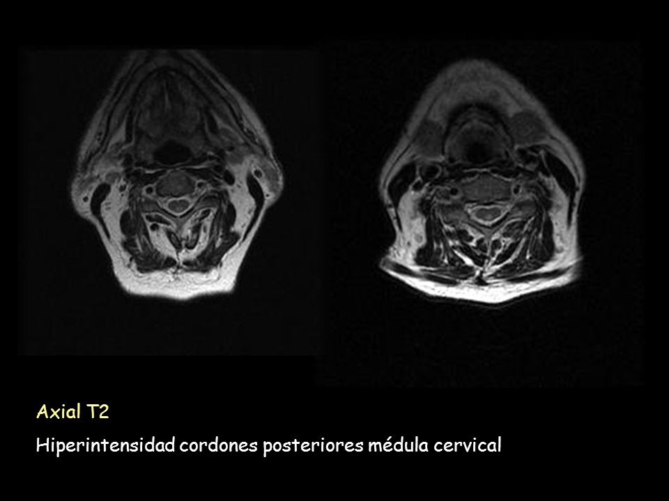 Axial T2 Hiperintensidad cordones posteriores médula cervical