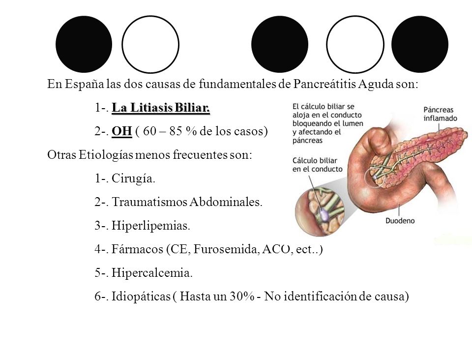 En España las dos causas de fundamentales de Pancreátitis Aguda son:
