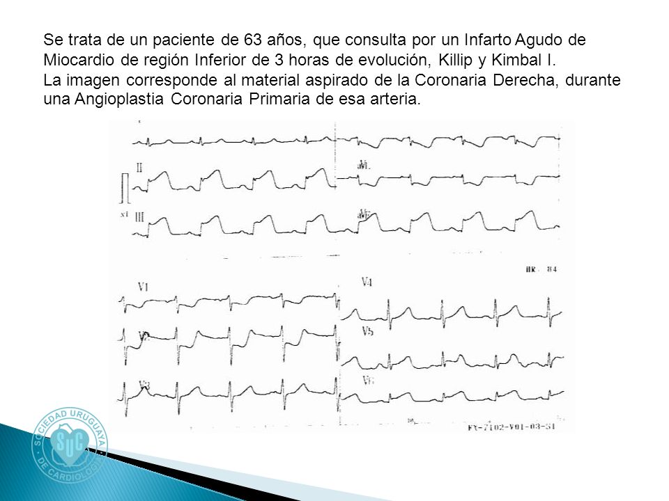 Se trata de un paciente de 63 años, que consulta por un Infarto Agudo de Miocardio de región Inferior de 3 horas de evolución, Killip y Kimbal I.