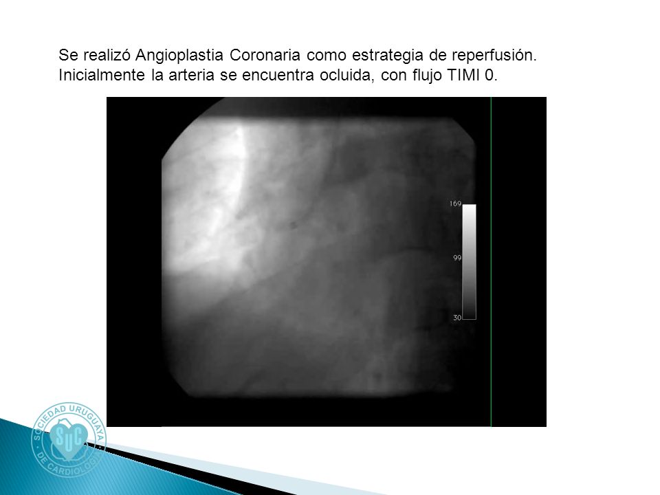 Se realizó Angioplastia Coronaria como estrategia de reperfusión