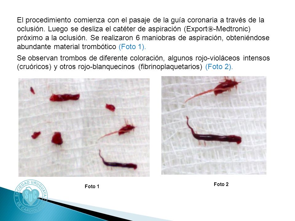 El procedimiento comienza con el pasaje de la guía coronaria a través de la oclusión. Luego se desliza el catéter de aspiración (Export-Medtronic) próximo a la oclusión. Se realizaron 6 maniobras de aspiración, obteniéndose abundante material trombótico (Foto 1). Se observan trombos de diferente coloración, algunos rojo-violáceos intensos (cruóricos) y otros rojo-blanquecinos (fibrinoplaquetarios) (Foto 2).