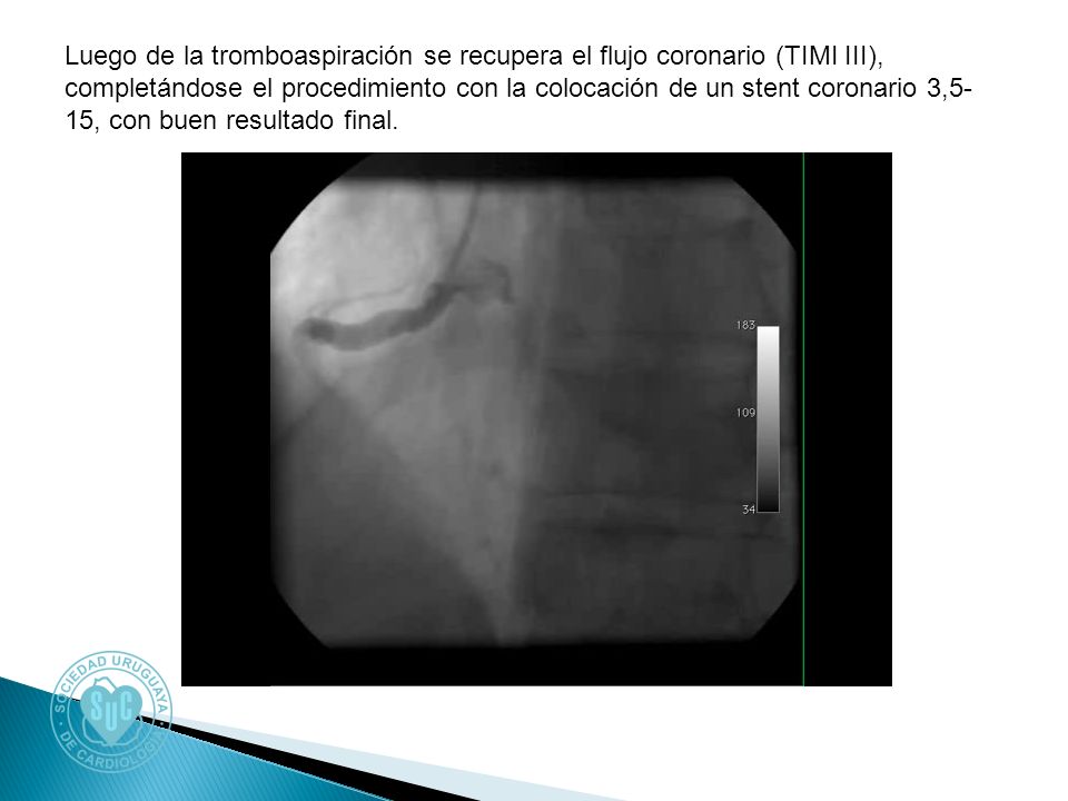 Luego de la tromboaspiración se recupera el flujo coronario (TIMI III), completándose el procedimiento con la colocación de un stent coronario 3,5- 15, con buen resultado final.