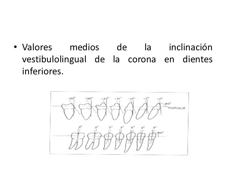 Valores medios de la inclinación vestibulolingual de la corona en dientes inferiores.