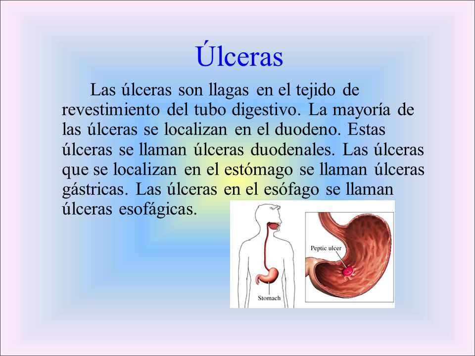 Úlceras