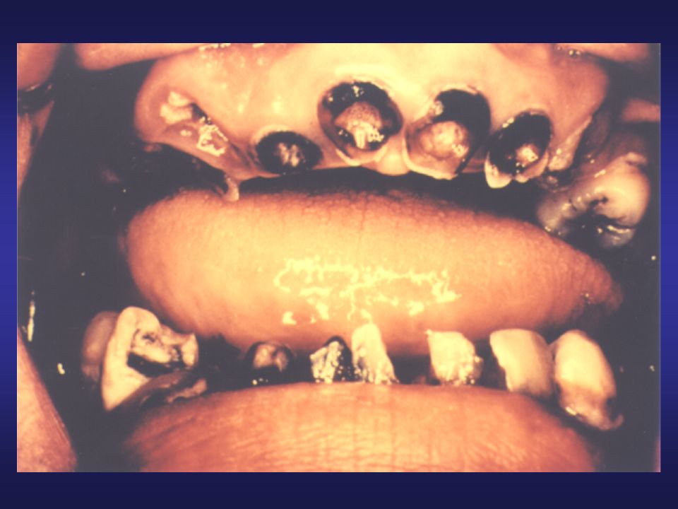 Lo primero que viene a la mente de mucha gente cuando se menciona el azúcar es, las caries dentales.