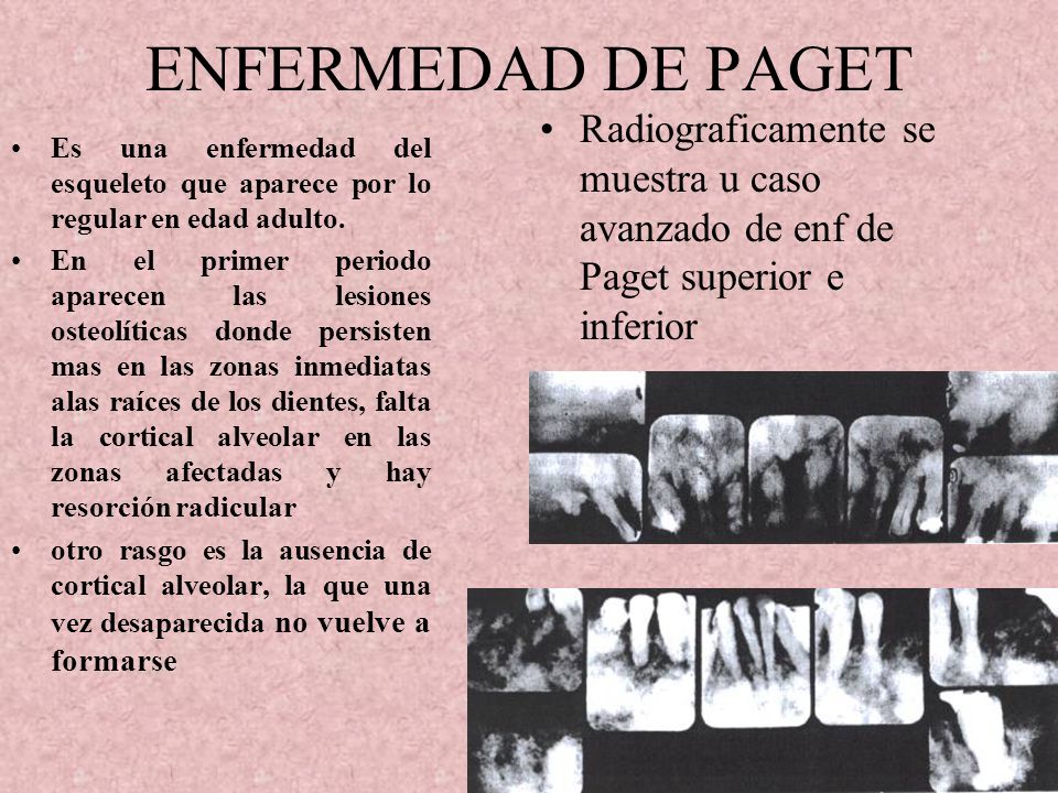 ENFERMEDAD DE PAGET Radiograficamente se muestra u caso avanzado de enf de Paget superior e inferior.