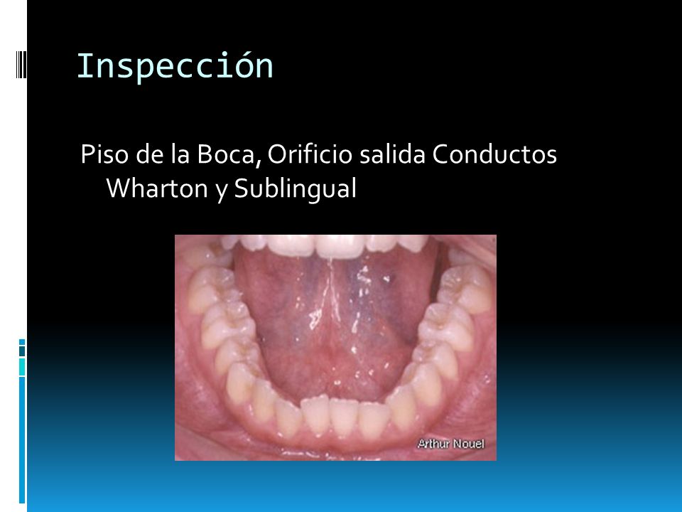 Inspección Piso de la Boca, Orificio salida Conductos Wharton y Sublingual